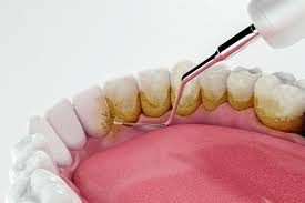 Plak ve Tartar Nedir?